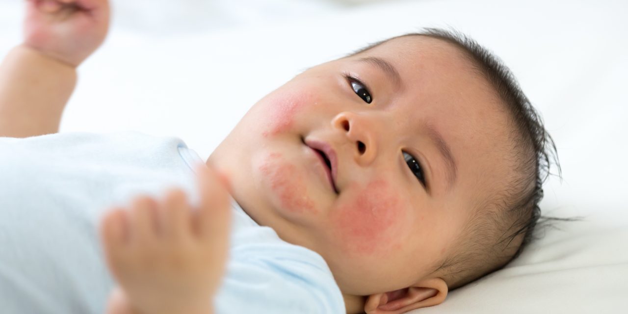 Eczema: There’s a Solution for Itchy Skin in Kids