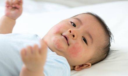 Eczema: There’s a Solution for Itchy Skin in Kids