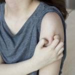 The Itches and Scratches of Hives